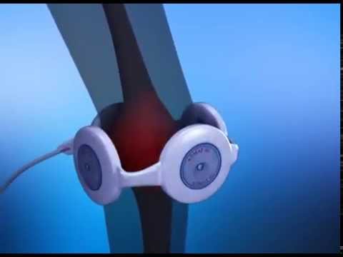 Алмаг на колено. Алмаг-01 на колено. Алмаг 1 коленный сустав. Алмаг 01 для коленного сустава. Аппарат для коленного сустава алмаг.